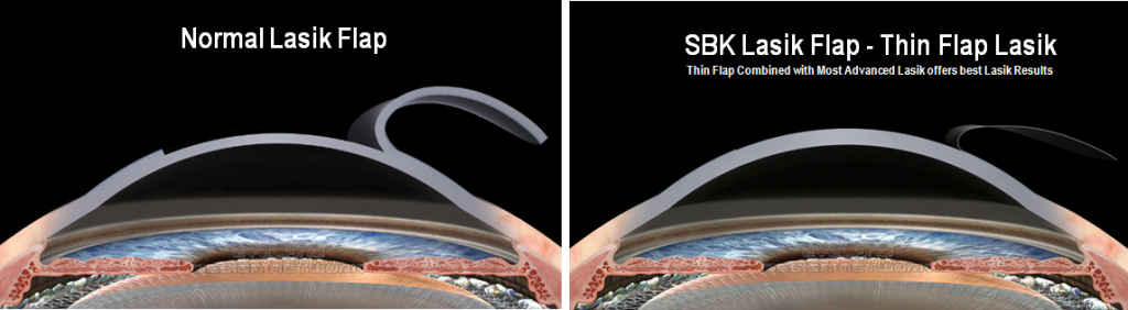 SBK Lasik Surgery in Pune