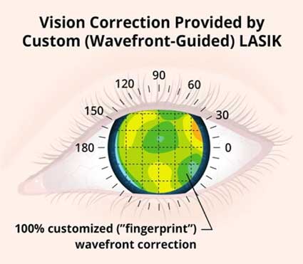 Standard-Lasik-vs-Standard-Lasik