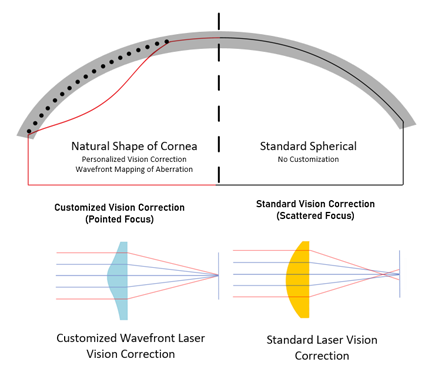 Customized-Lasik-vs-Standard-Lasik