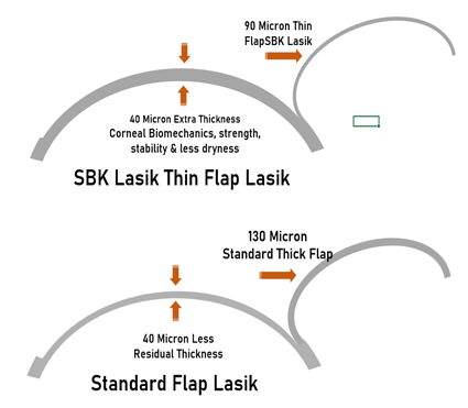 SBK-thin-flap-Lasik-vs-Standard-Lasik